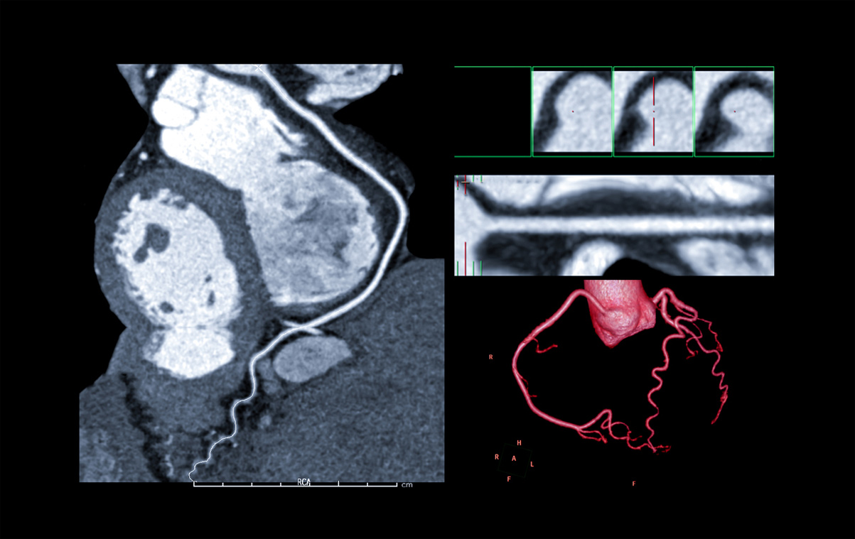 Coronary CT Angiogram