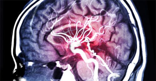 Neurovascular IR